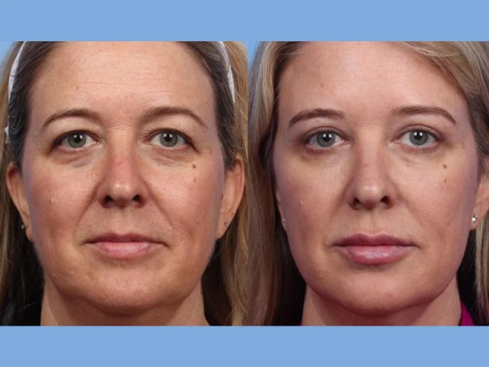 liquid facelift before and after in uae