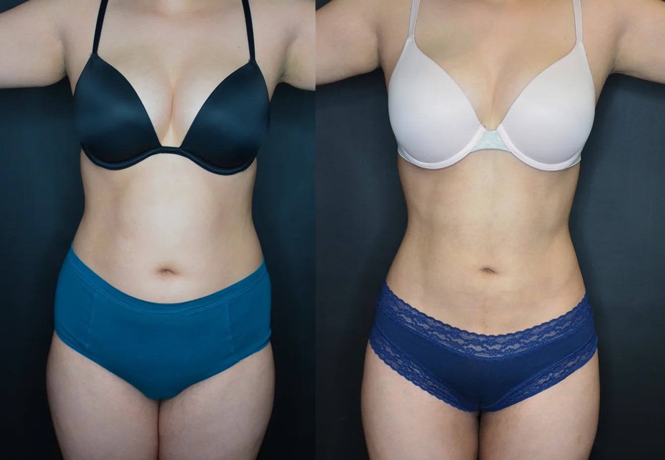 Microaire liposuction at perfect drs dubai