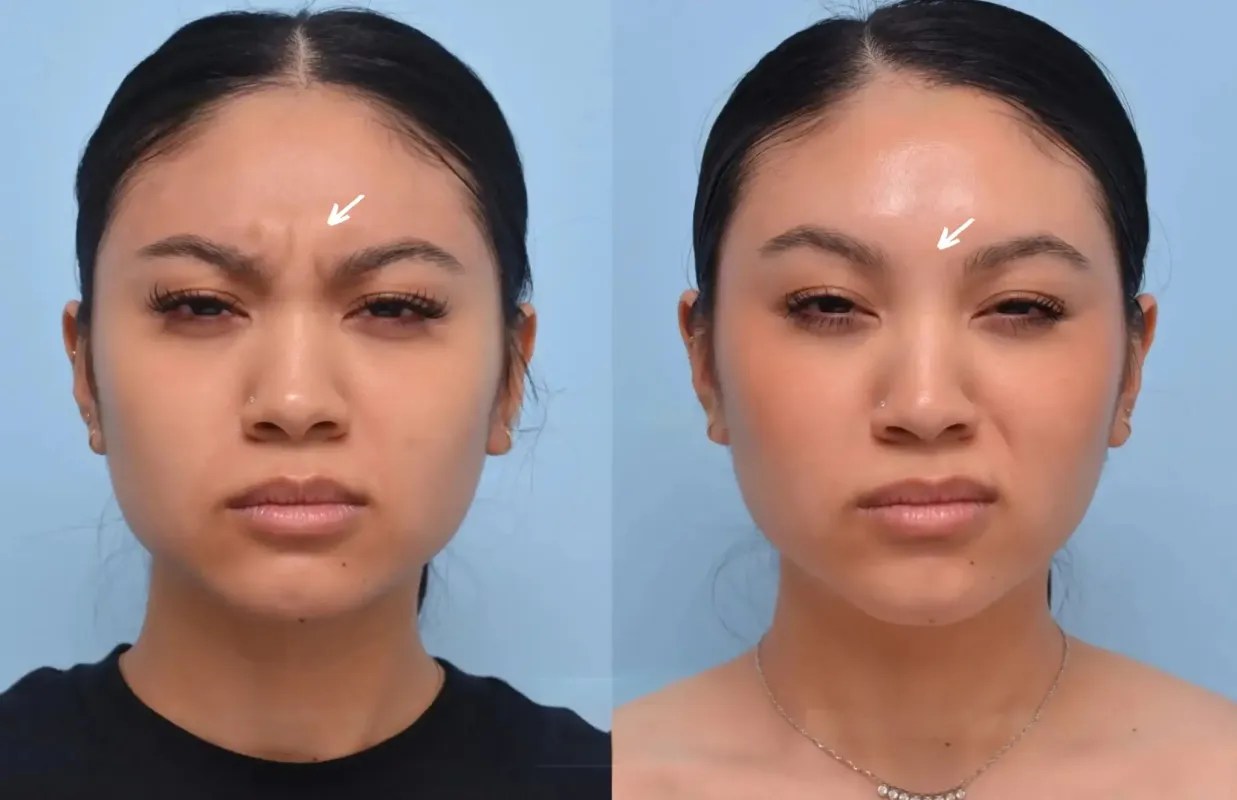 Botulax before after uae