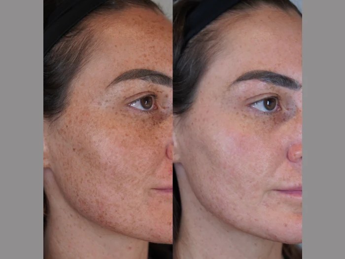 Broad Band Light Therapy in Uae