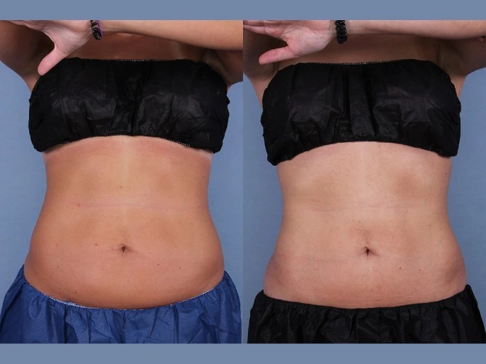 Cryolipolysis before after result