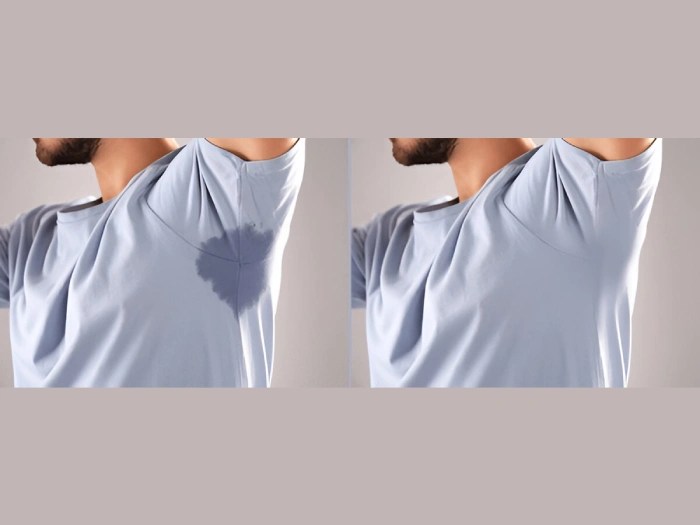 Excessive Sweating In Abu Dhabi