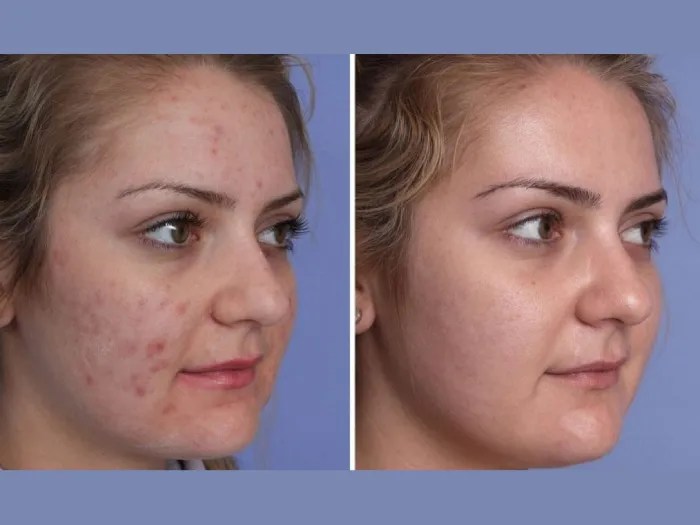 Led Light Therapy in Uae