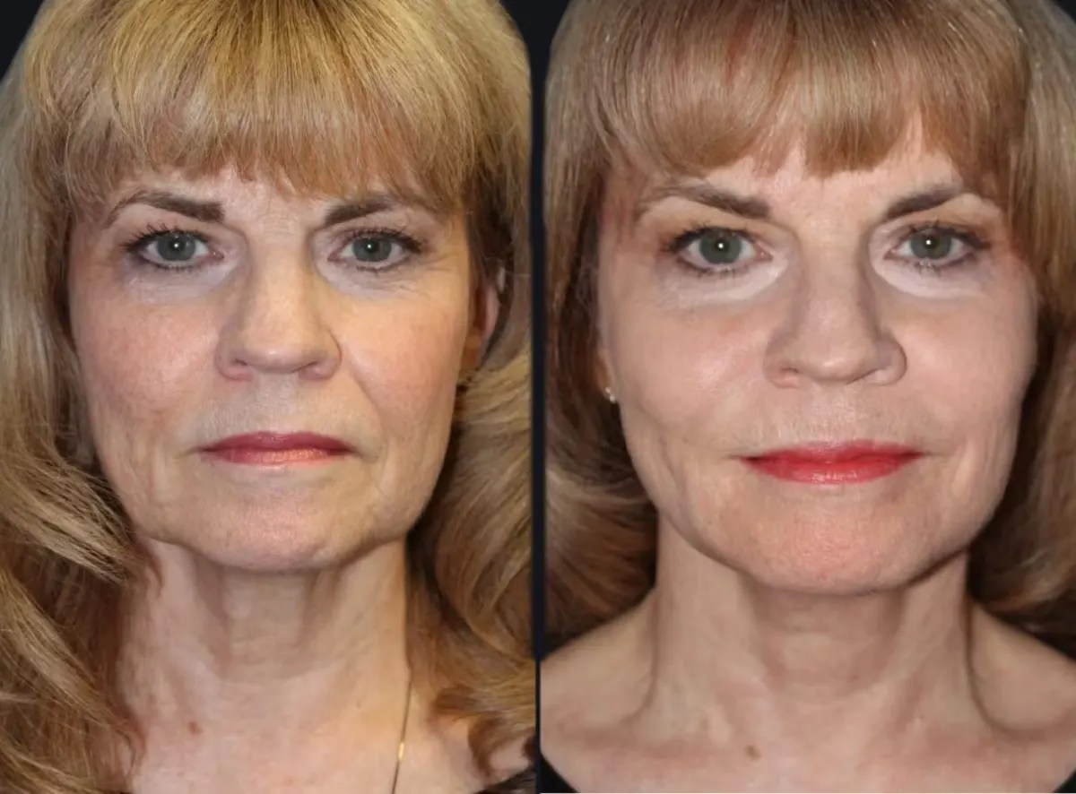 Laser Photo Rejuvenation at perfect drs dubai