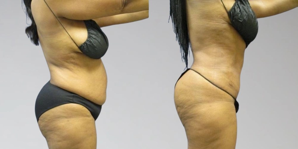 Lipolysis Injections at perfect drs dubai
