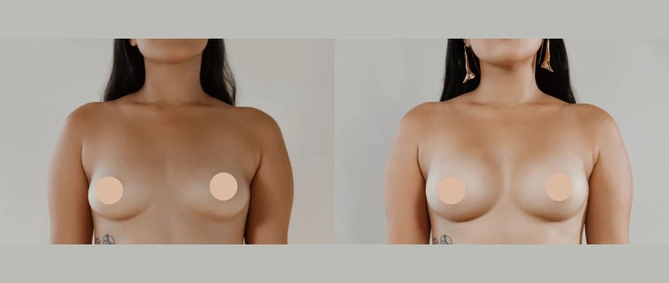 Mia femtech breast implants in dubai abu dhabi uae results