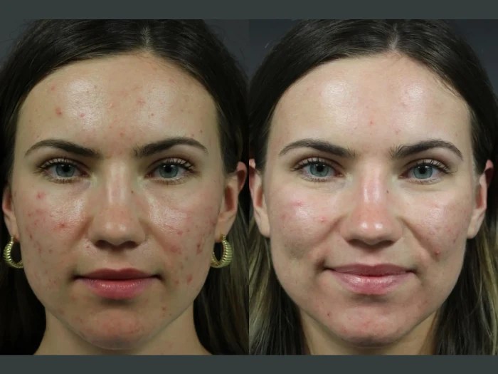 Radio Frequency for Acne Scars before after uae