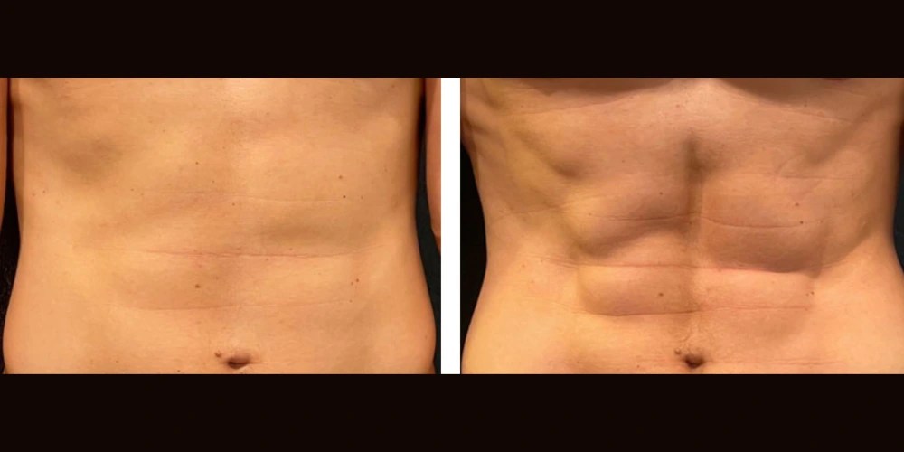 Trusculpt Flex at Perfect Drs