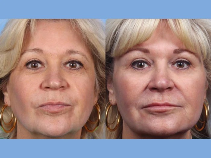 liquid facelift before after in abu dhabi