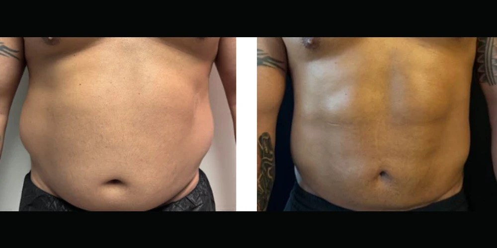 Body Jet Liposuction In Abu Dhabi