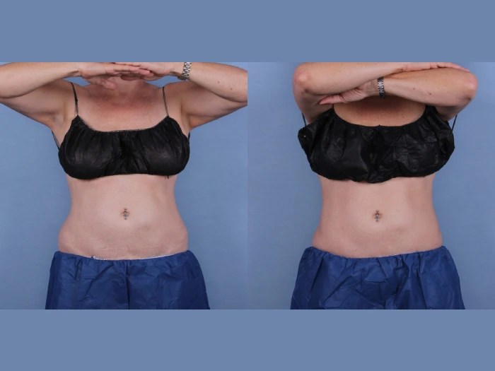 Cryolipolysis in dubai