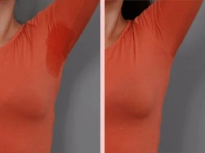 Hyperhidrosis Treatment In Dubai