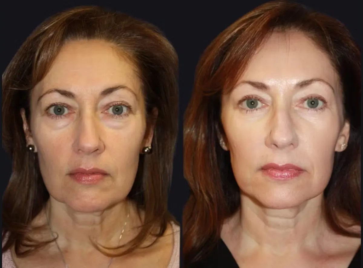 Laser Photo Rejuvenation at perfect drs