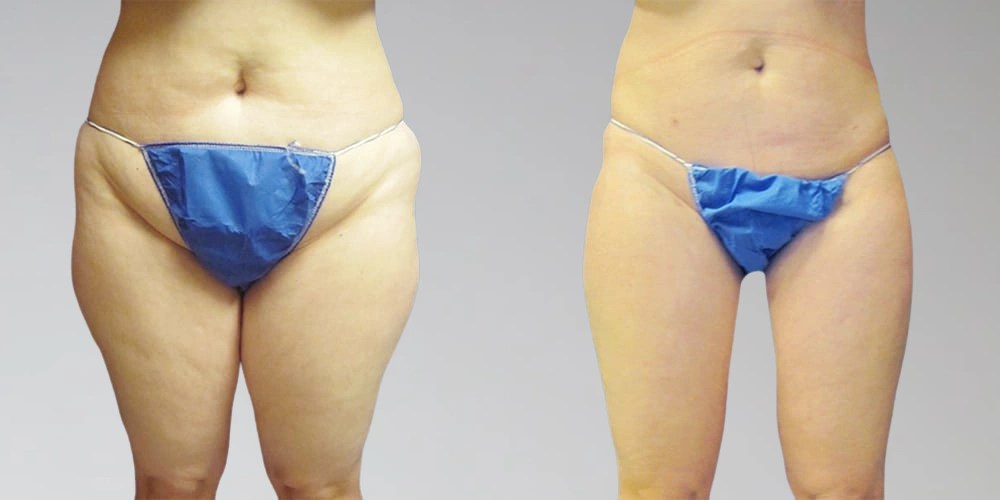 Lipolysis Injections before after uae