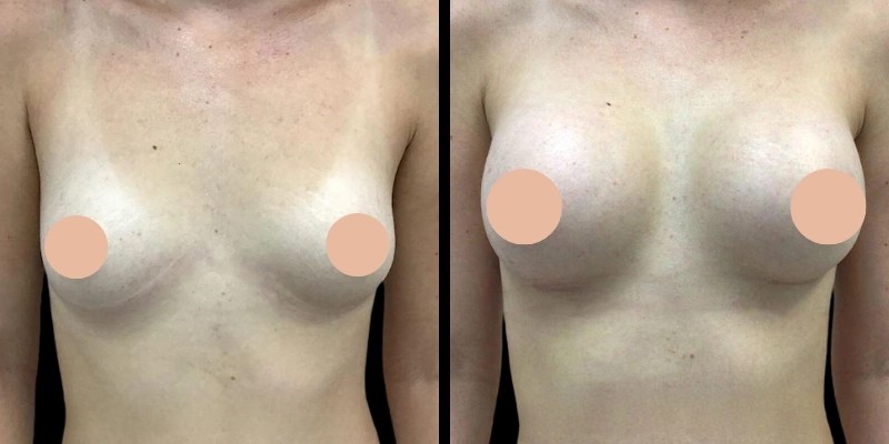 Mia femtech breast augmentation before and after in uae