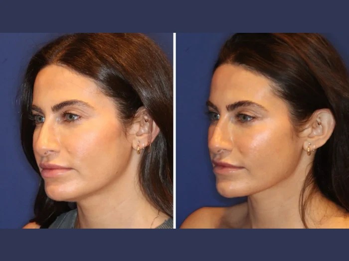Nefertiti lift before after at perfect drs