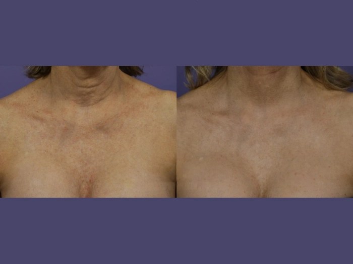 Pico Laser Dubai Before After