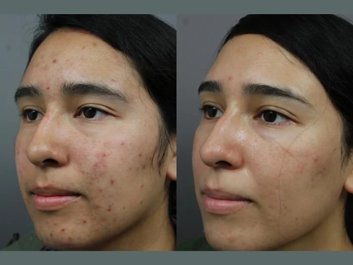 Radio Frequency for Acne Scars before after abu dhabi