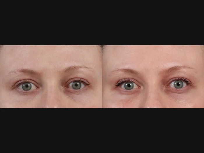 Secret Rf Microneedling Before After Abu Dhabi