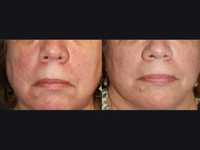 Skin Rejuvenation at Perfect Drs
