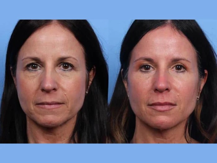 liquid facelift for man in dubai