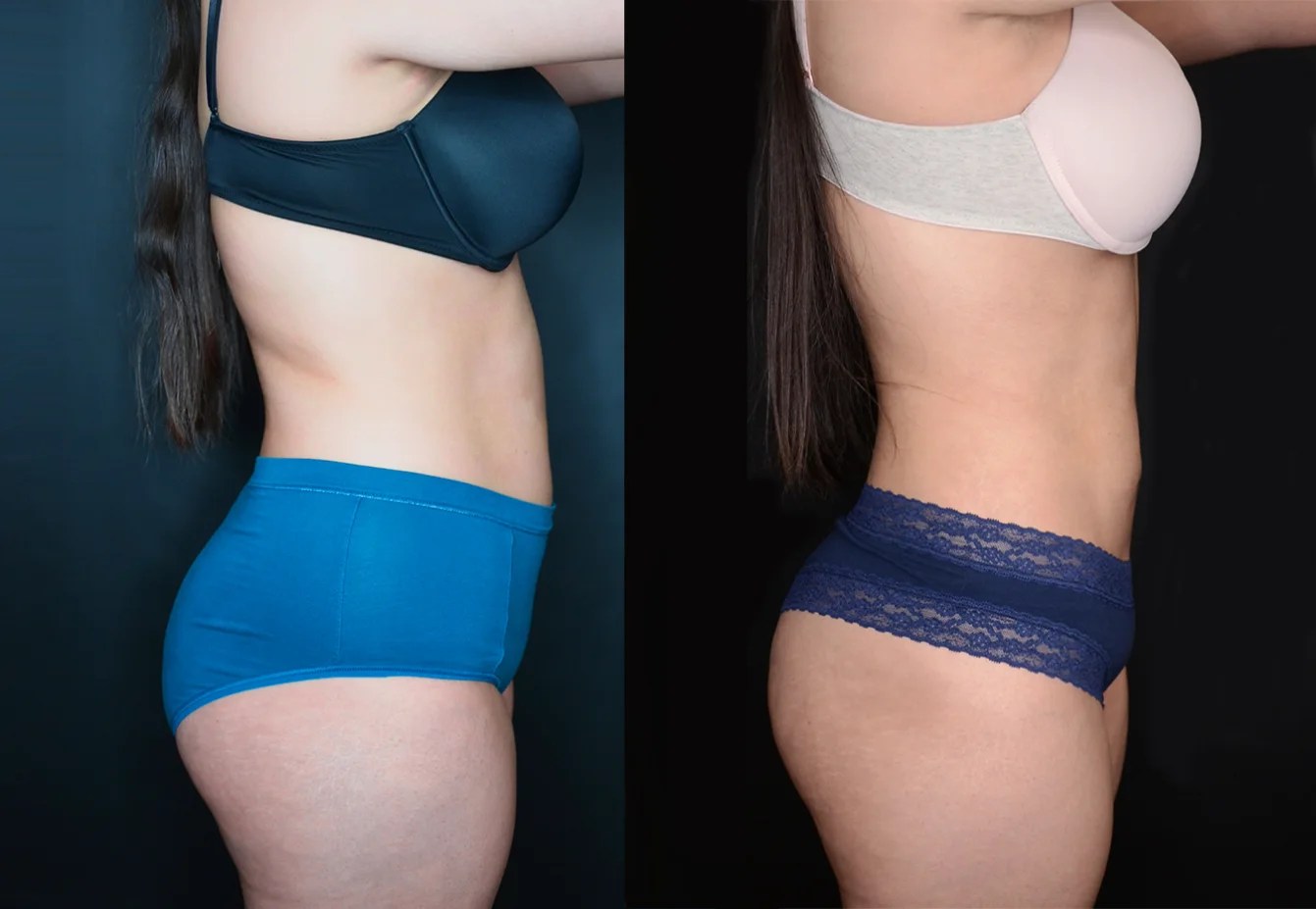 Microaire liposuction before after