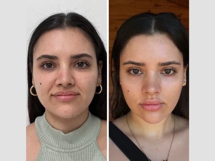 Vampire Facelift Abu Dhabi Before After