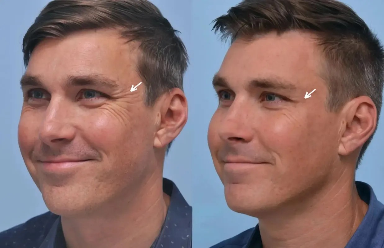 Botulax before and after