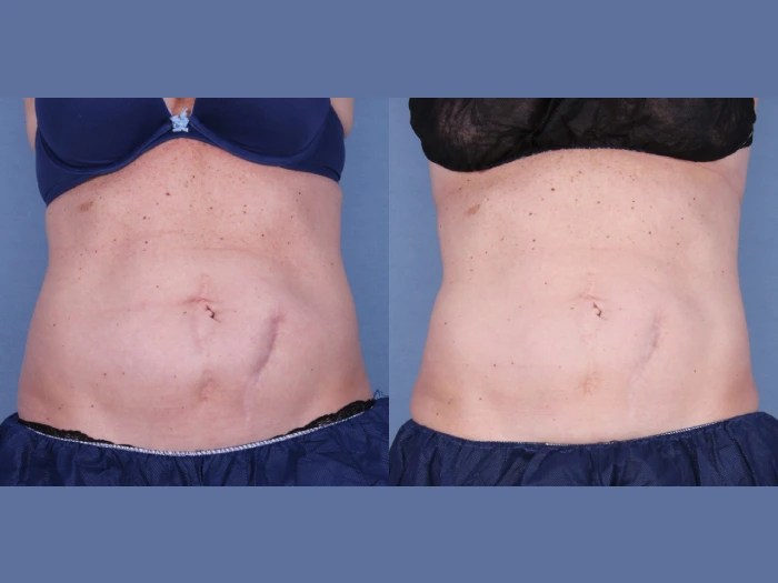 Cryolipolysis in uae