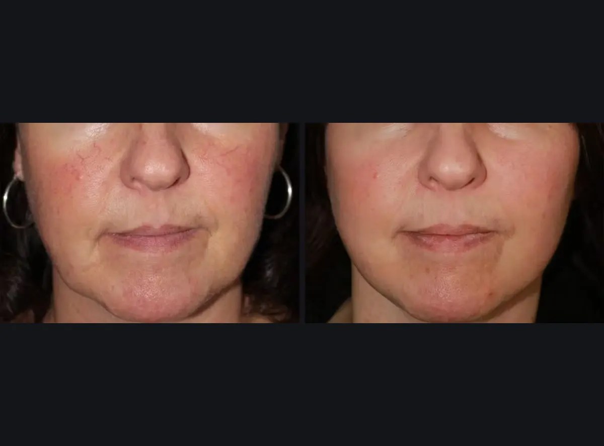 Laser Photo Rejuvenation results Abu dhabi