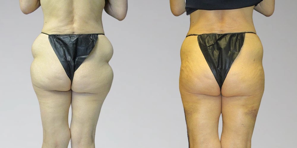 Lipolysis Injection In Abu Dhabi