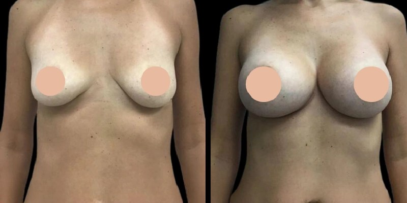 Mia femtech breast augmentation before after in abu dhabi