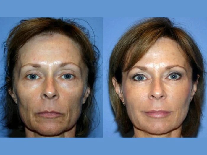 liquid facelift before and after