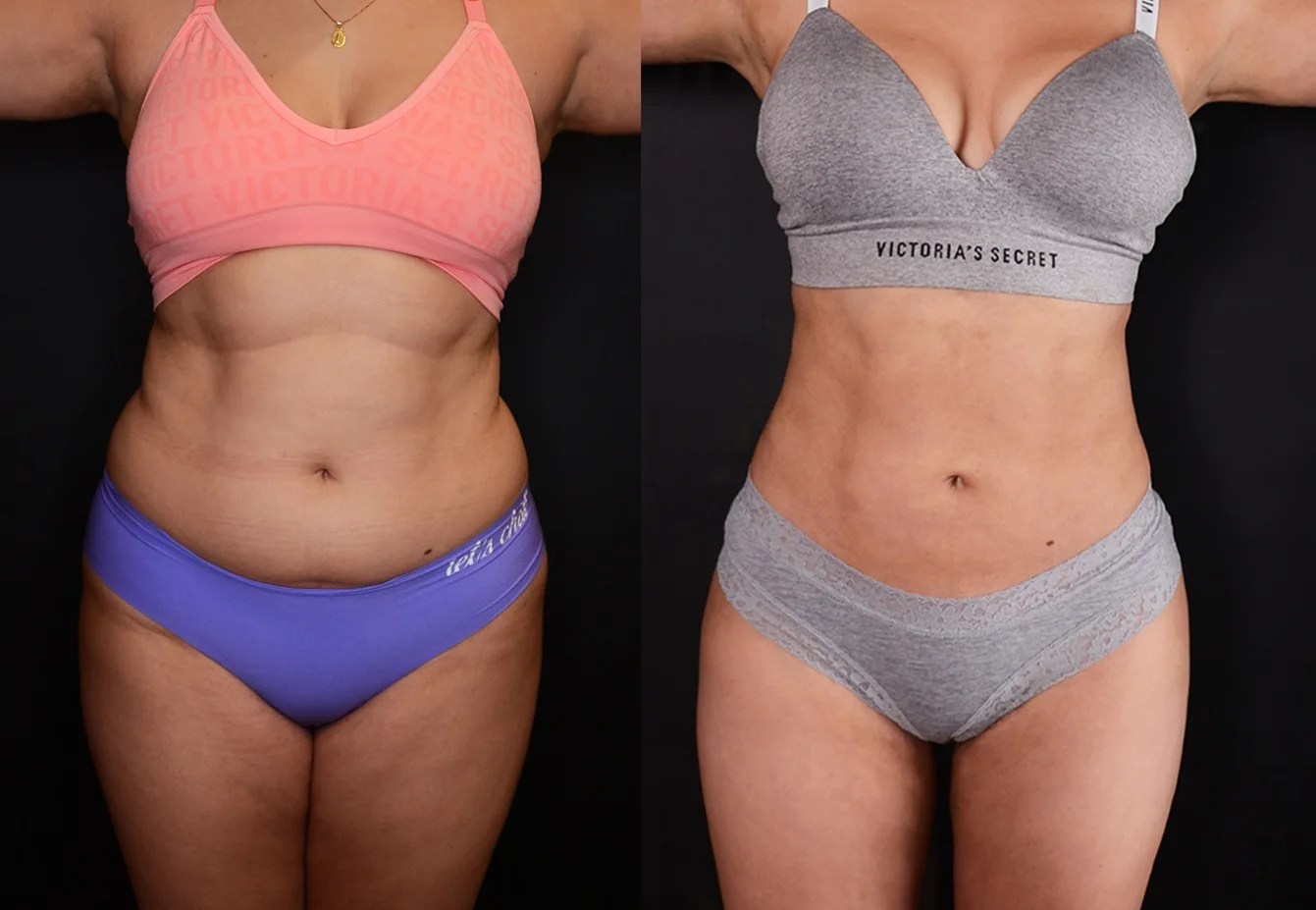 Microaire liposuction before after dubai