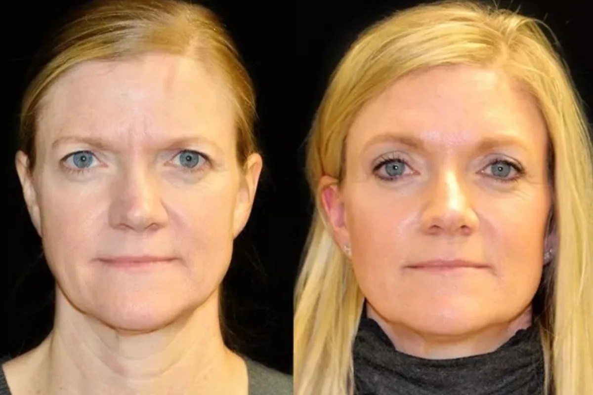 Botox Forehead Lift In Abu Dhabi