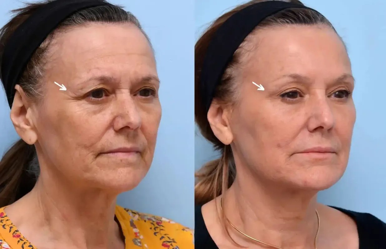 Botulax before after in dubai