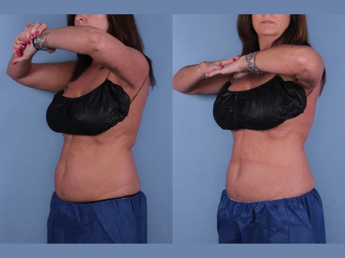 Cryolipolysis before after result in uae