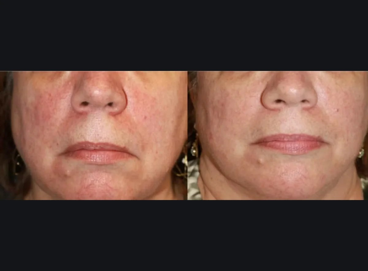Laser Photo Rejuvenation before after in dubai