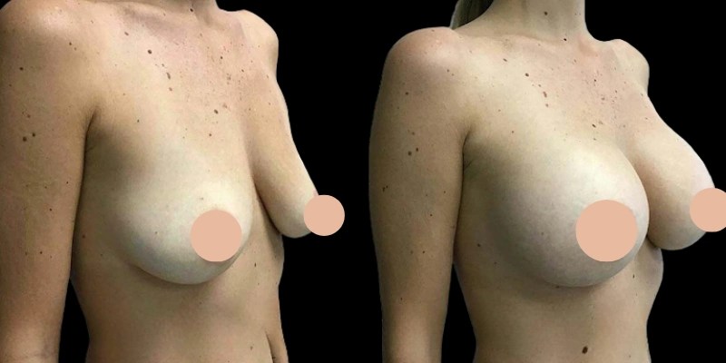 Mia femtech breast augmentation in dubai