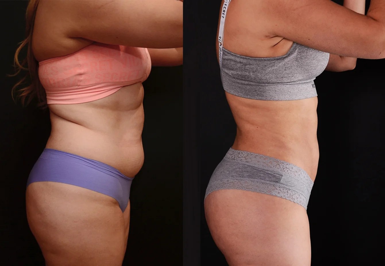 microaire liposuction Before and after in Dubai Abu Dhabi