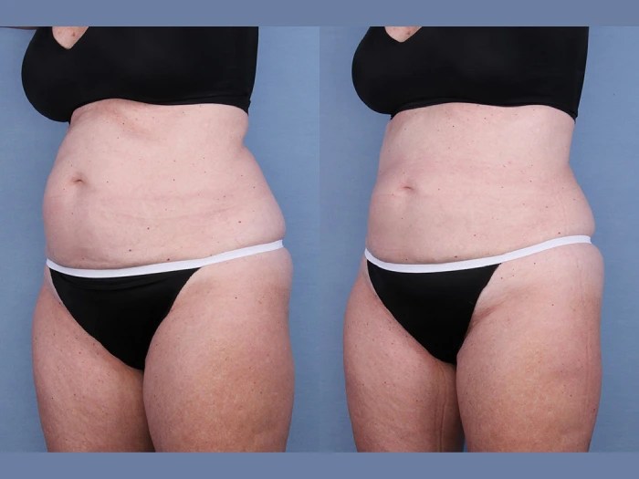 Cryolipolysis before after abu dhabi
