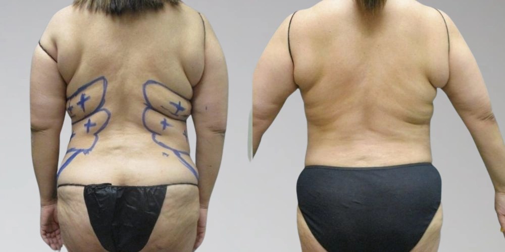 Lipolysis Injection In Dubai
