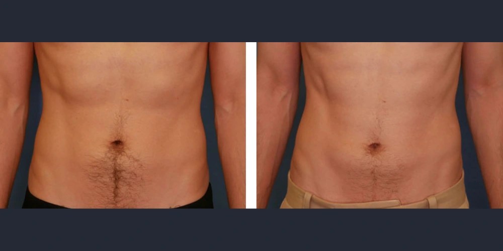 Trusculpt Flex Abu Dhabi