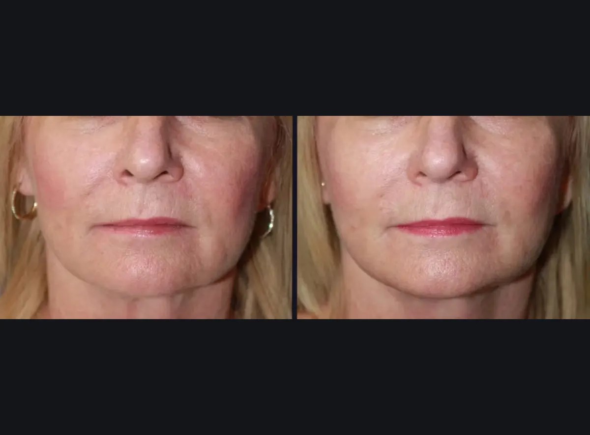 Laser Photo Rejuvenation before after result