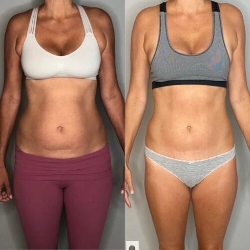 Smart lipo before after results dubai