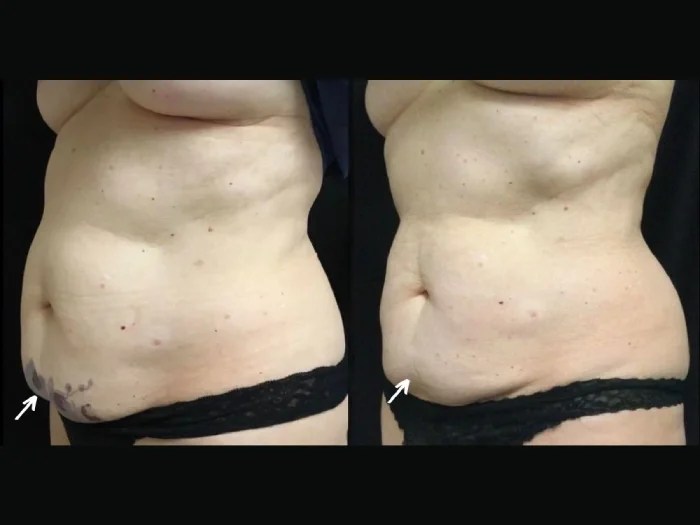 Coolmini Treatment Before After