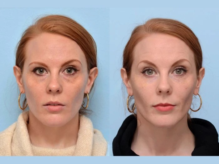 Botox under eyes