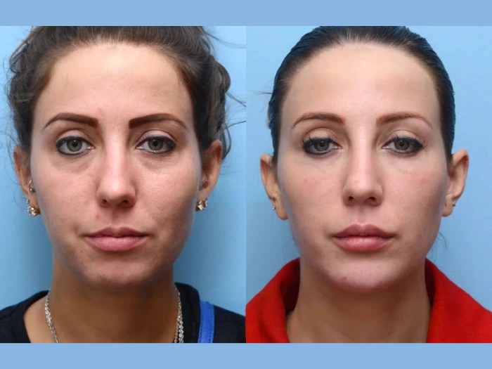 Botox under eyes