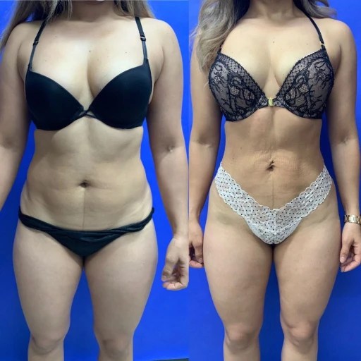 Smart lipo before after results
