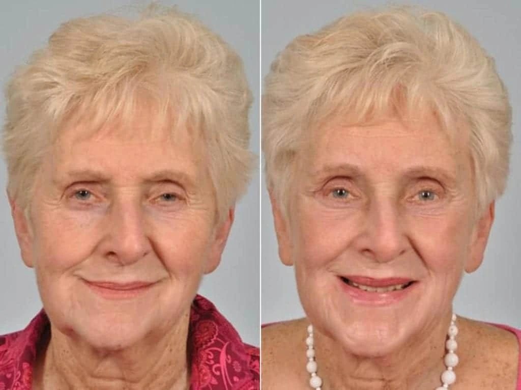 Saggy eyelid treatment before after result in uae